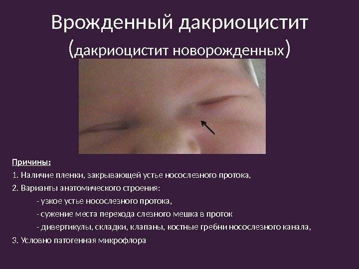 Массаж слезного канала у новорожденных при дакриоцистите - видео (Комаровский)