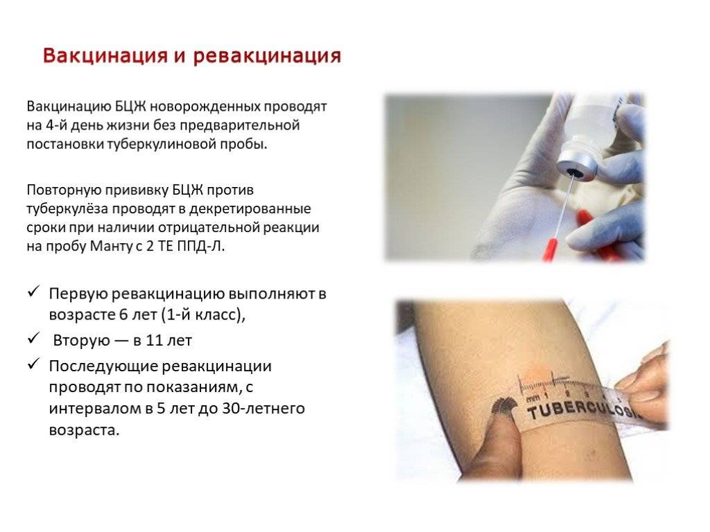 Бцж расшифровка у новорожденных. БЦЖ прививка внутрикожно. Техника проведения вакцинации БЦЖ И БЦЖ М. Прививка против туберкулеза (БЦЖ). Вакцинация против туберкулеза проводится подкожно.