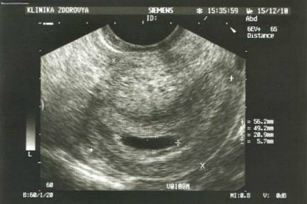 Неполный аборт - задержка плодного яйца в матке