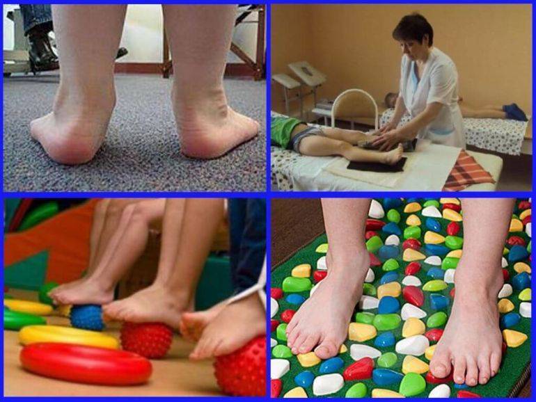 Варусная деформация стопы. причины и лечение варусной деформации стопы у детей