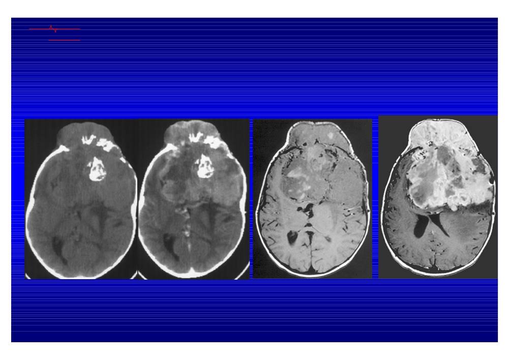 Стадии рака головного мозга: симптомы, диагностика, лечение, фото