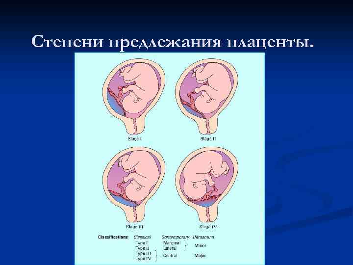 Предлежание хориона что это значит. Краевое предлежание зева. Краевое предлежание плаценты. Плацента от внутреннего зева 1 см.