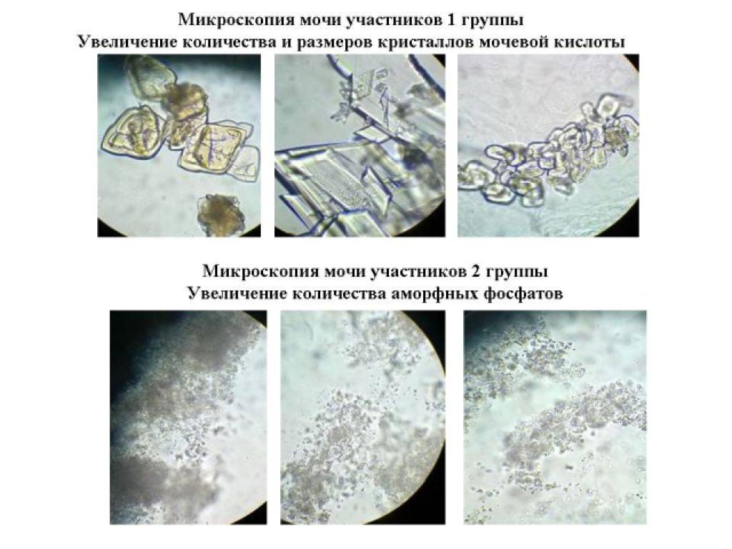 Аморфные фосфаты в моче. Поляризационная микроскопия кристаллов мочевой кислоты. Микроскопия мочи соли. Лейкоциты в моче микроскопия. Микроскопия осадка мочи неорганизованный осадок.