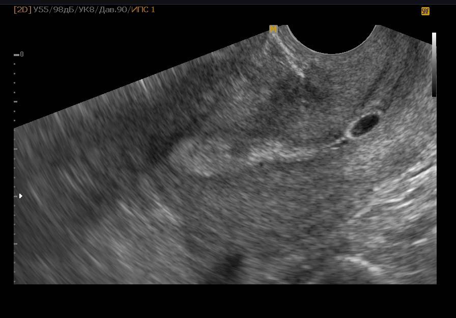 Могут ли перепутать кисту с беременностью на узи (1нед задержки) - вопрос гинекологу - 03 онлайн