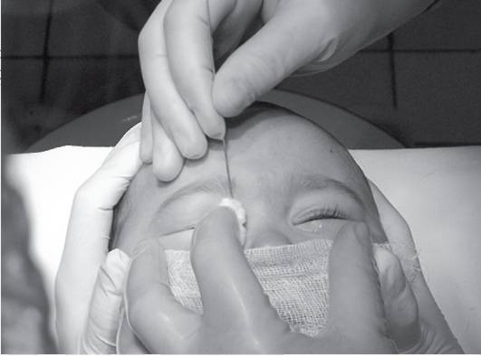Массаж слёзного канала у новорожденного, мнение е. о. комаровского