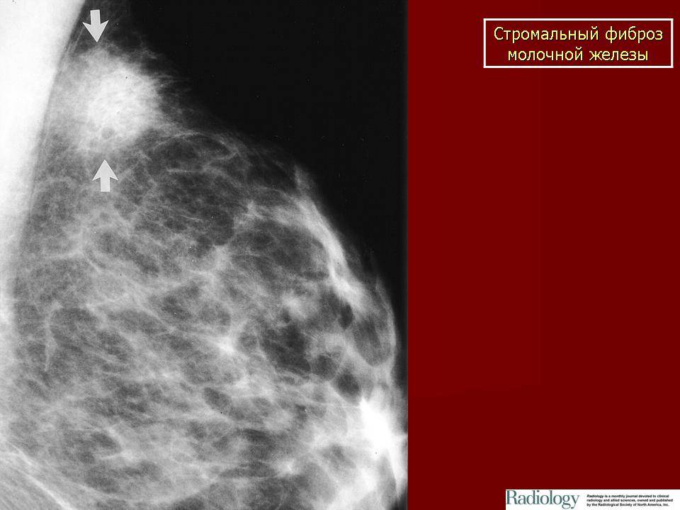 Фиброз грудной клетки: характеристики и методы лечения