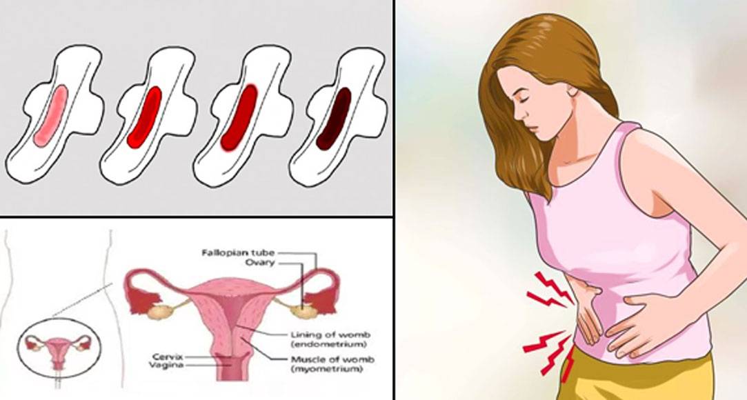Маточное кровотечение во время и после менструации: меноррагия и метроррагия