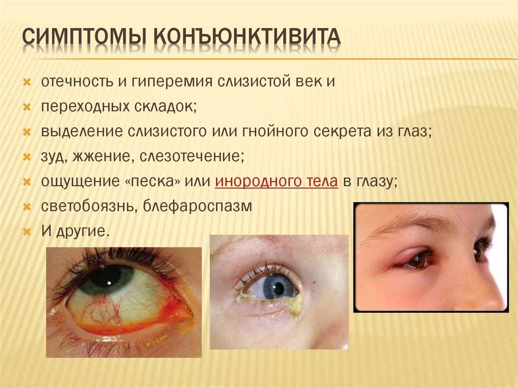 Вирусный конъюнктивит у детей: лечение заболевания глаз, симптомы с фото