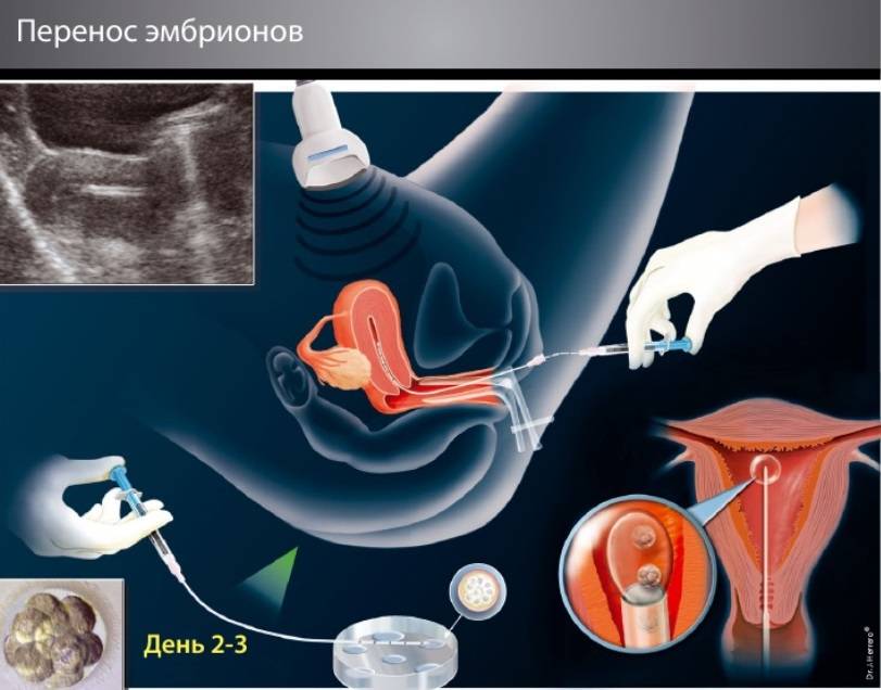 Признаки беременности после переноса эмбрионов