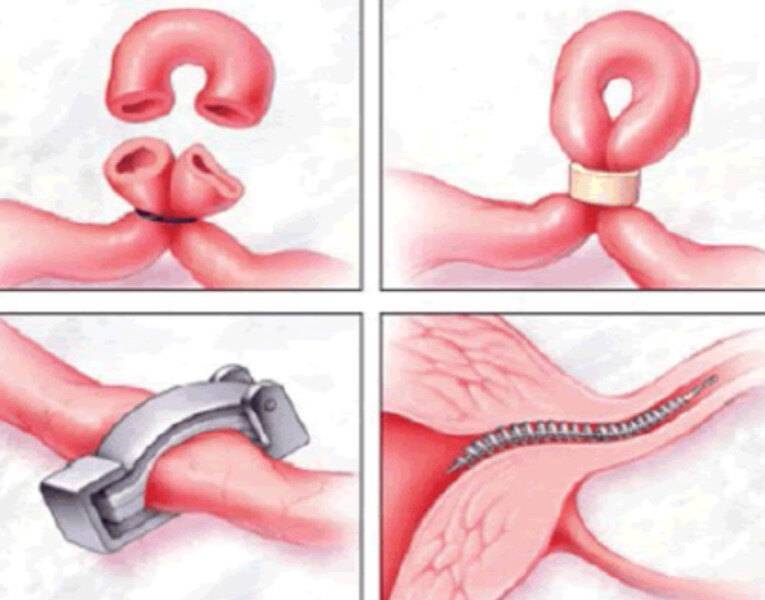 Операция лапароскопия маточных труб: последствия, реабилитация, стоимость, отзывы