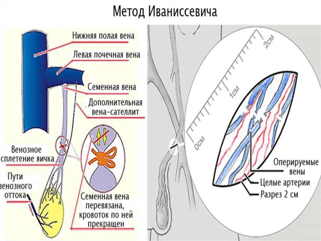 Варикоцеле – операция, период реабилитации, стоимость в москве | клиника «линия жизни»