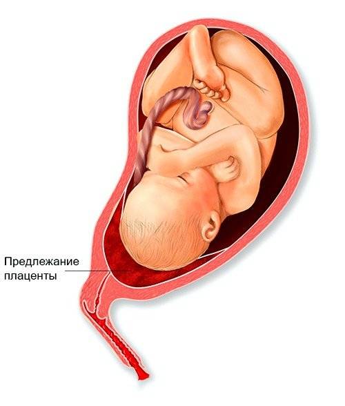 Плацента по передней стенке матки | baby boom - портал будущих родителей