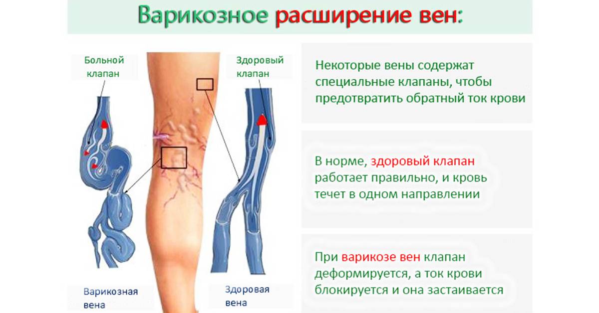 Атеросклероз нижних конечностей – облитерирующий и хронический - причина онемения ног.