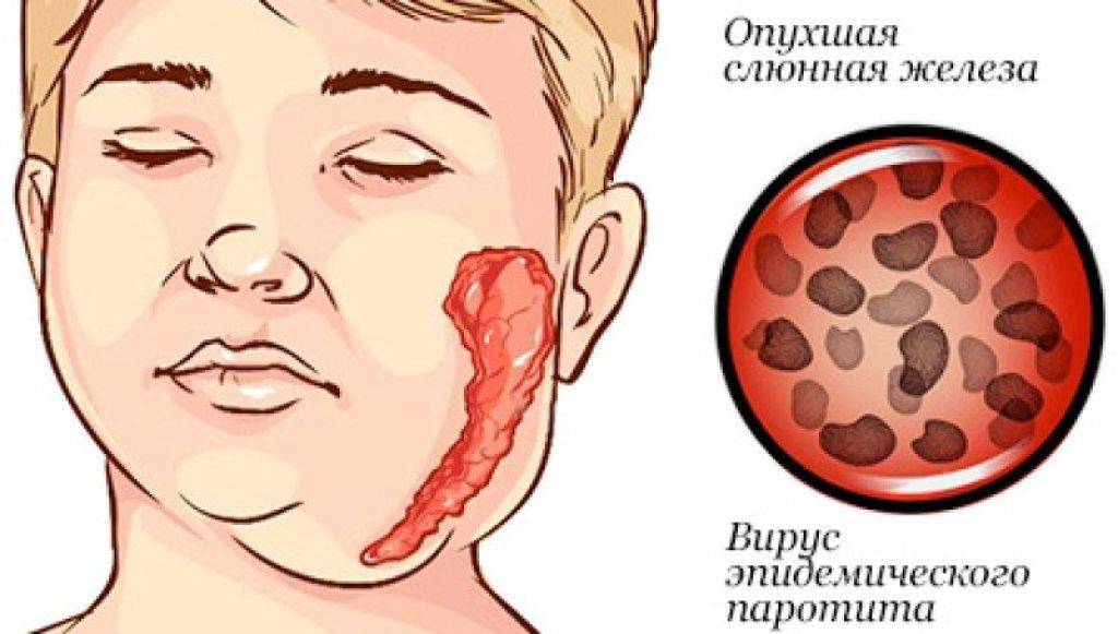 Свинка | симптомы | диагностика | лечение - docdoc.ru