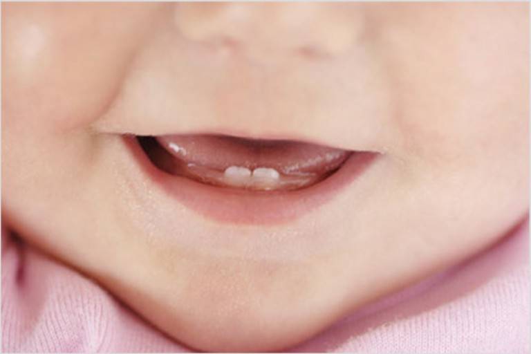 Затрудненное прорезывание зубов у детей - как облегчить