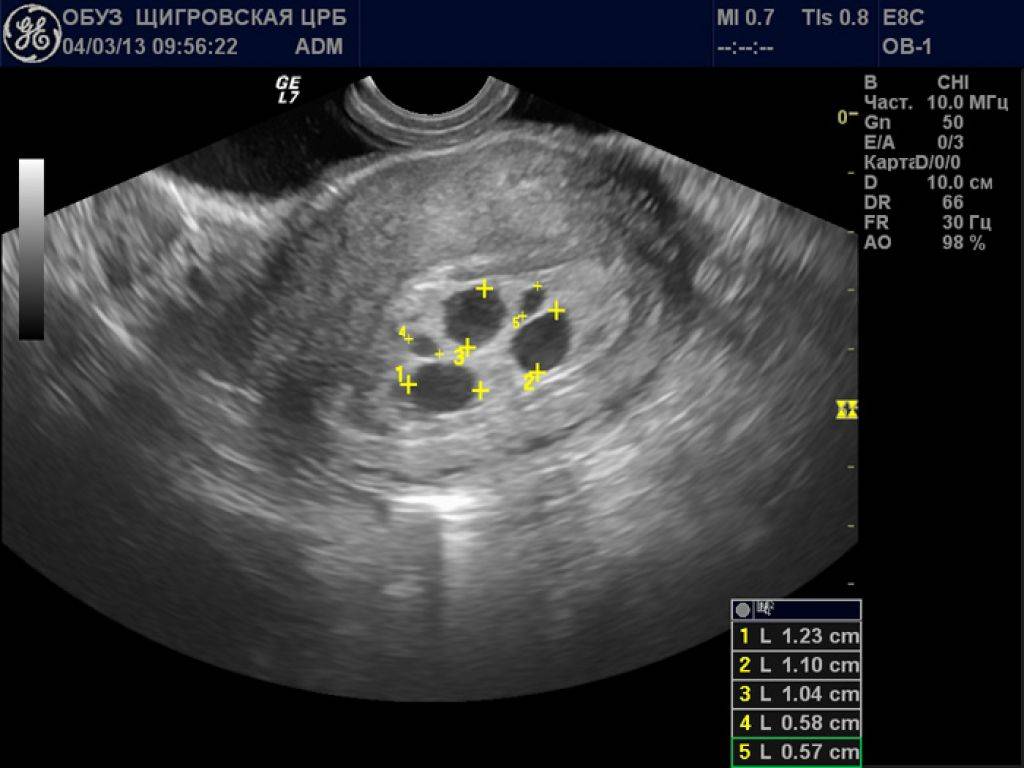 Как улучшить кровоток в матке при планировании беременности и перед переносом эмбрионов для ЭКО?