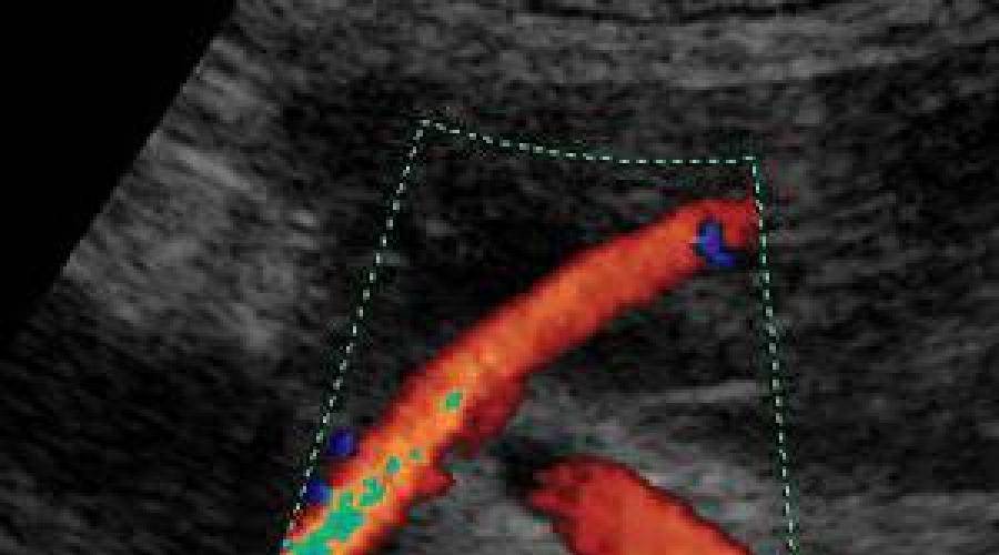 Маточная артерия при беременности: норма по допплерометрии, расшифровка результатов