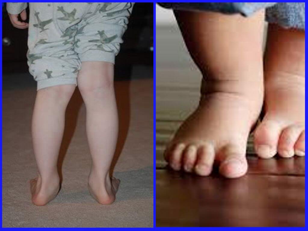 Вальгусное искривление ног у ребенка: причины и лечение | детская поликлиника
