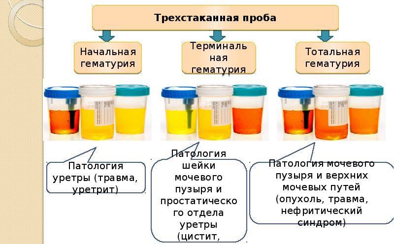 Моча розового цвета у ребенка