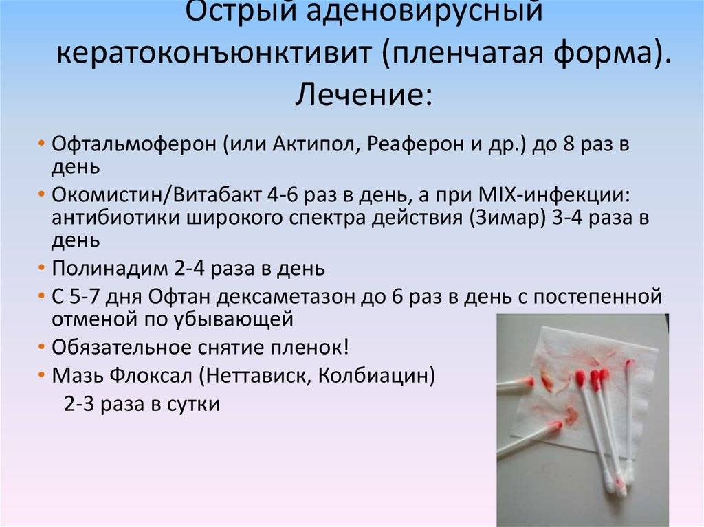 Конъюнктивит у детей: симптомы, лечение, профилактика - энциклопедия ochkov.net