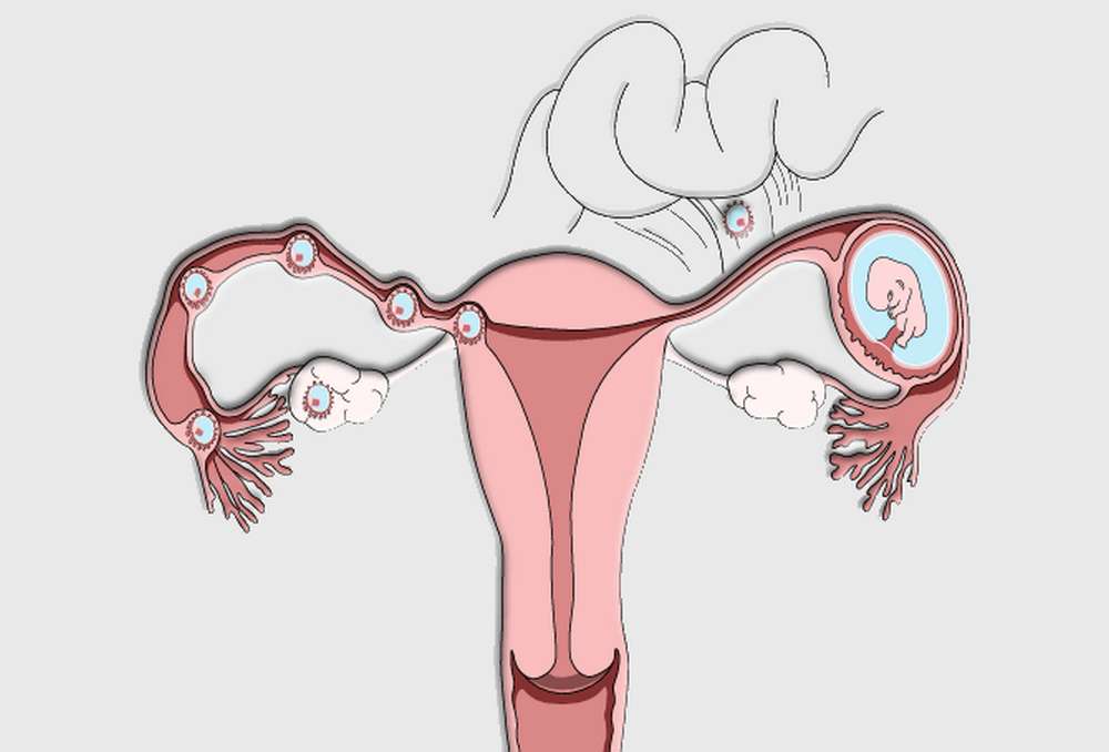 Удаление матки будут ли месячные. Матка внематочная беременность. Матка при внематочной беременности. Яичниковая внематочная беременность. Маточная беременность и внематочная беременность.