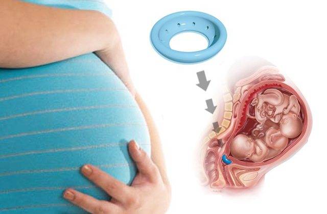 Акушерский пессарий, как метод коррекции ицн и предупреждения преждевременных родов.