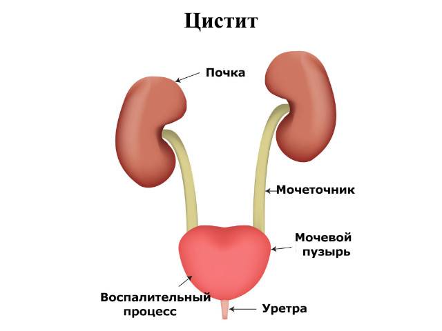 Цистит - симптомы, причины развития, лечение