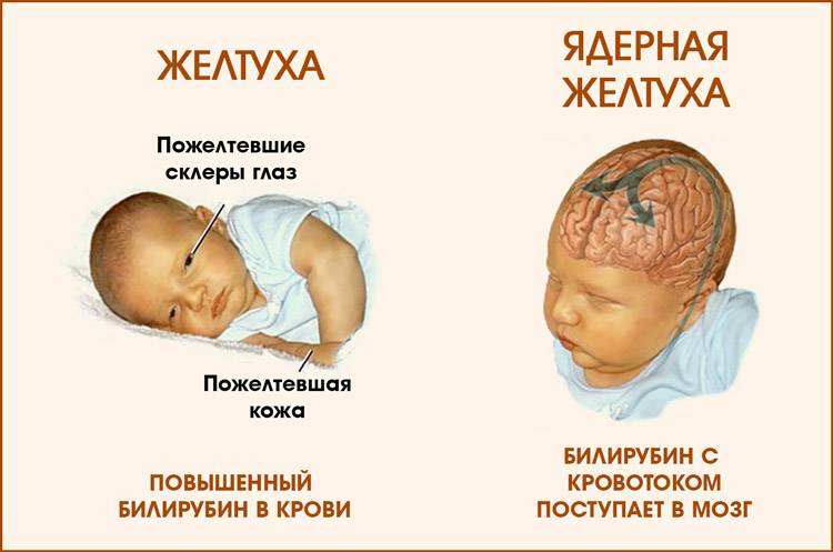 Желтушка у новорожденных. причины и последствия. норма. лечение