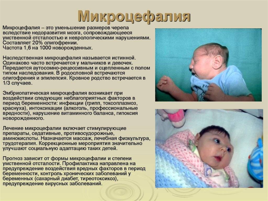 Стридор у новорожденных (врожденный) - симптомы патологического шумного дыхания у детей до года