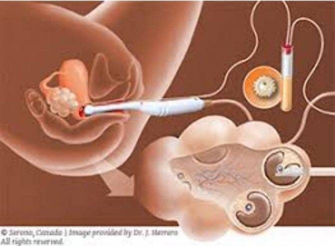 Лапароскопия перед ЭКО: зачем проводят, через сколько времени после процедуры можно беременеть?
