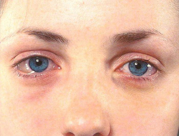Мешки под глазами у ребенка: причины, почему появляются отеки и припухлость до и после 1 года