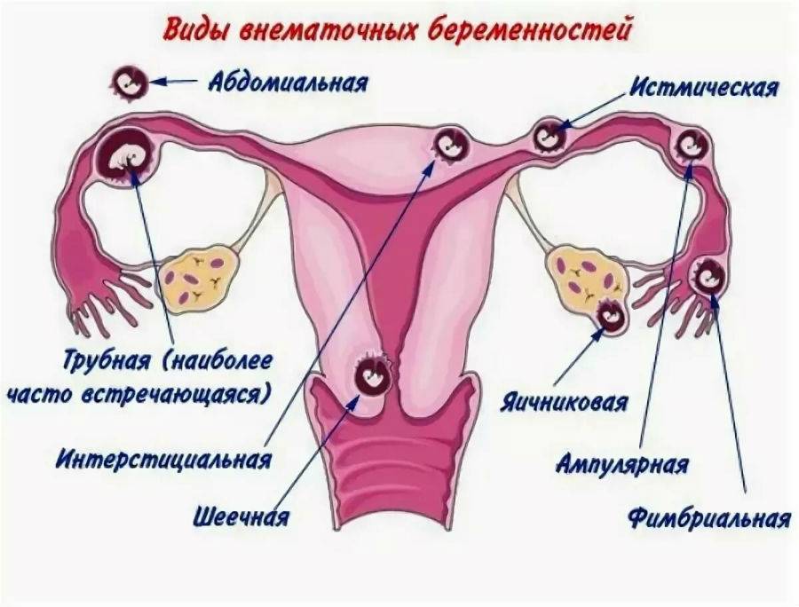 Внематочная беременность. что это, причины возникновения и в чем опасность — клиника isida киев, украина