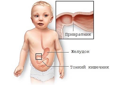 Пилоростеноз у детей - симптомы болезни, профилактика и лечение пилоростеноза у детей, причины заболевания и его диагностика на eurolab
