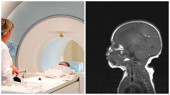 Расшифровка мрт головного мозга  как выглядит мрт снимок головы в норме