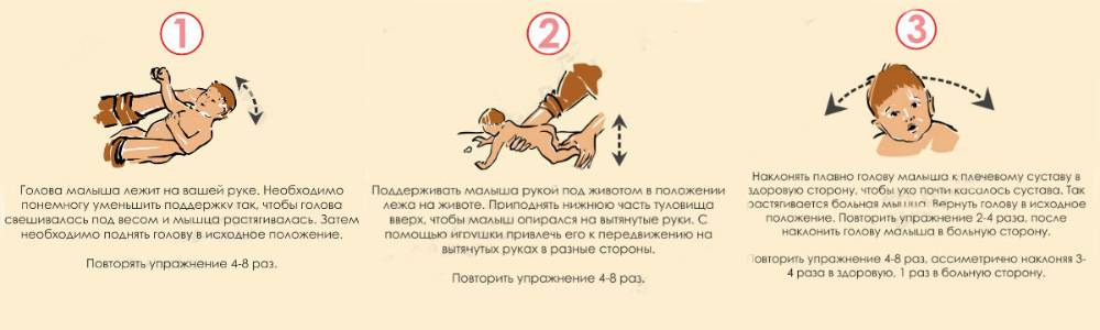Лечение кривошеи у новорожденного в самаре, кривошея у ребенка