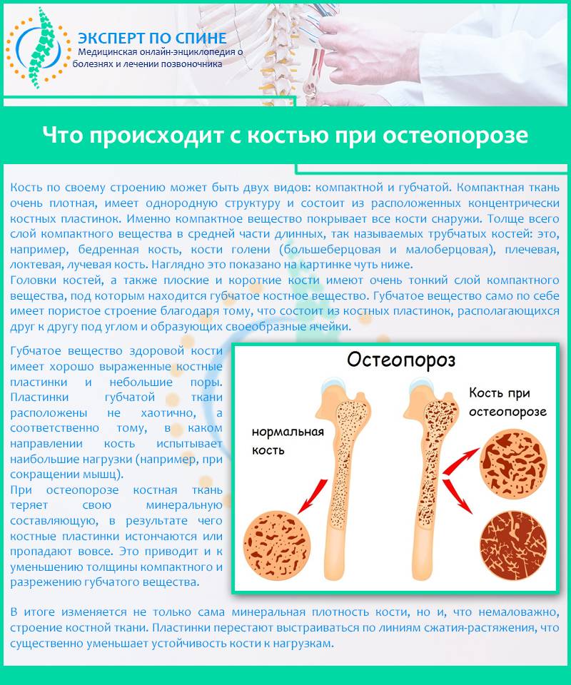 Остеопороз