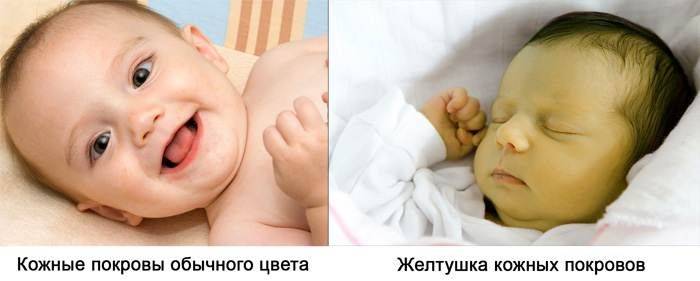 Ребенок желтуха почему. Желтушность кожных покровов у новорожденного. Неонатальная желтушка у новорожденного. Желтуха при галактоземии.