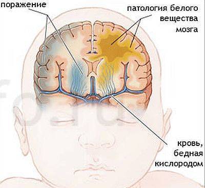 Пороки развития головного мозга | медико-генетический центр «геномед»