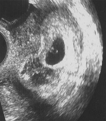 Замершая беременность, пустое плодное яйцо и аналогичные аномалии