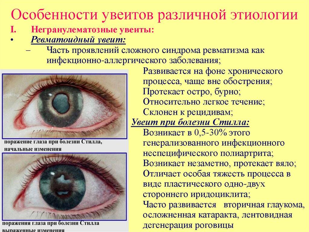 Красные глаза у детей