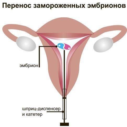Эко и имплантация эмбриона | на какой день делать перенос эмбрионов