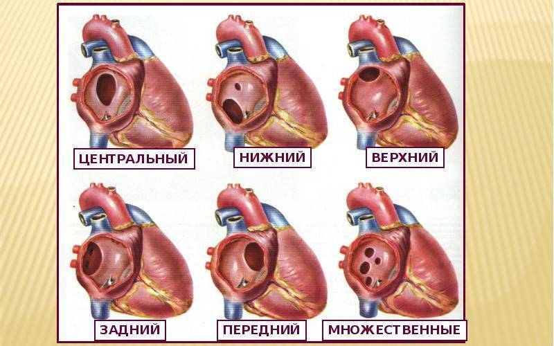 Эндоваскулярное лечение порока сердца