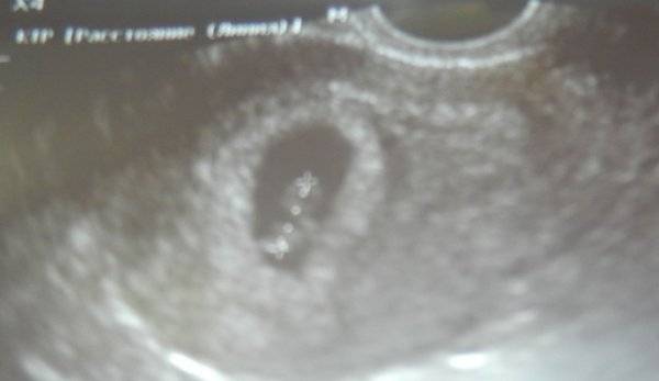 Первые симптомы оплодотворения: когда и как распознать беременность? | аборт в спб