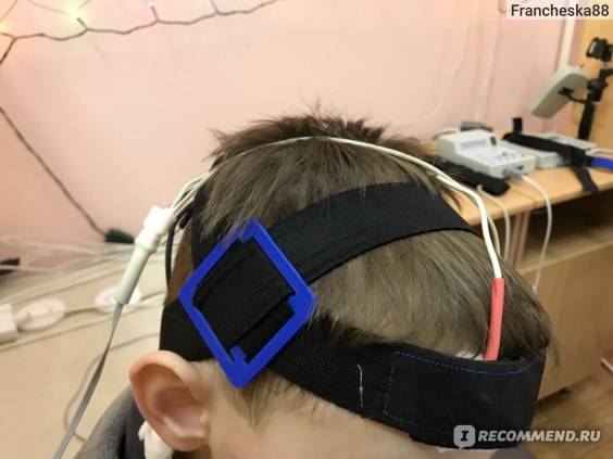 Микрополяризация головного мозга детям: показания и противопоказания курса ТКМП