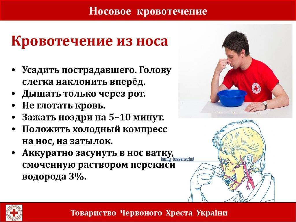 Носовое кровотечение: почему оно возникает и как устранить причины?