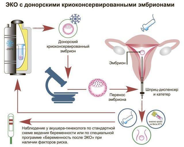 Перенос эмбрионов при эко