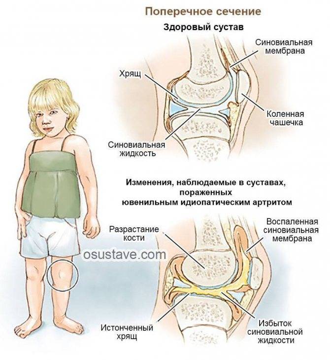 Воспаление тазобедренного сустава у ребенка - симптомы, причины и лечение артрита