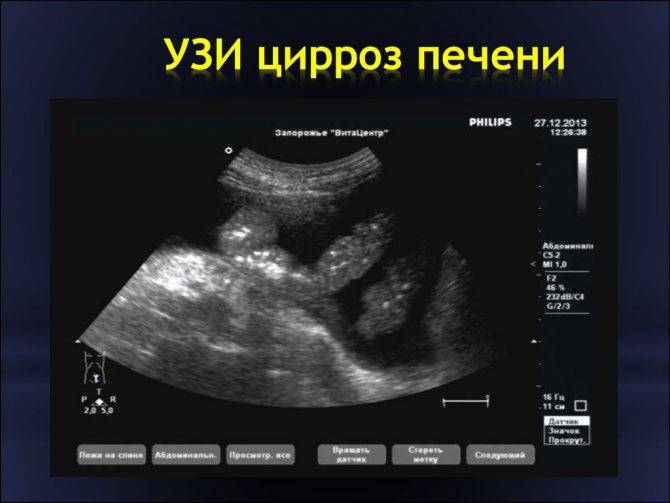 Гепатомегалия печени