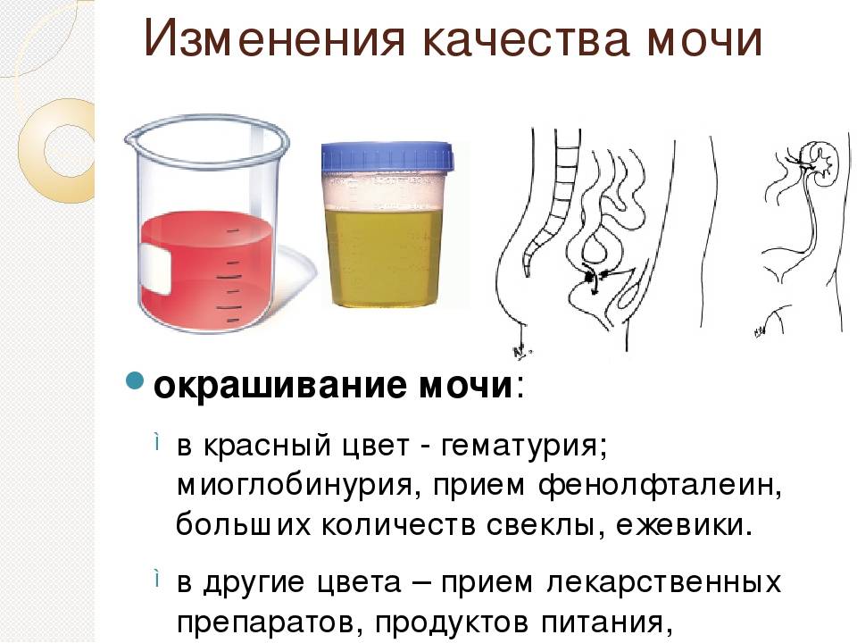 Урологические расстройства -